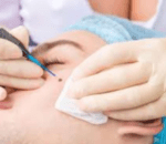 Step 3 Targeted Removal Procedure