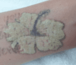 Step 4 Pigment Breakdown Healing